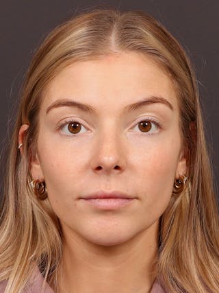 Primary Rhinoplasty Before & After Gallery - Patient 378034 - Image 4