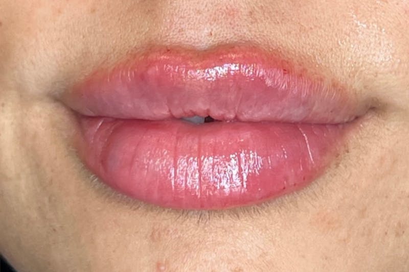 Lip Filler Before & After Gallery - Patient 179261 - Image 2