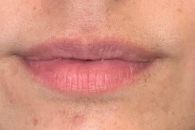 Lip Filler Before & After Gallery - Patient 179261 - Image 1