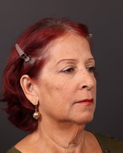 Neck Lift Before & After Gallery - Patient 418837 - Image 1