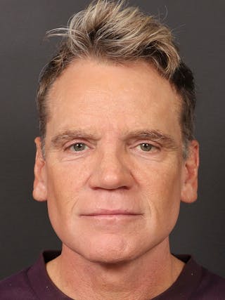 Facelift Before & After Gallery - Patient 336754 - Image 2