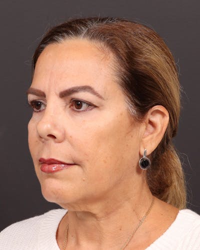 Neck Lift Before & After Gallery - Patient 670451 - Image 1