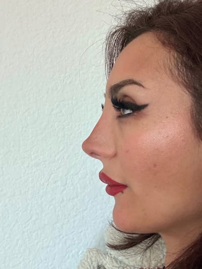 Revision Rhinoplasty Before & After Gallery - Patient 231712 - Image 2