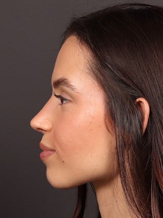 Primary Rhinoplasty Before & After Gallery - Patient 247542 - Image 2