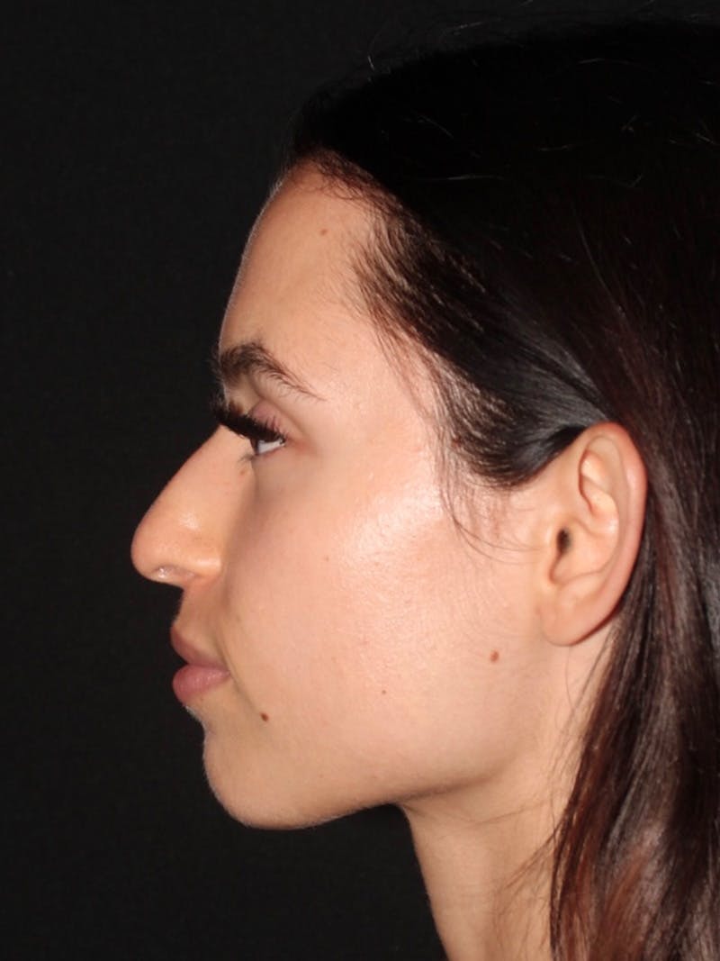 Primary Rhinoplasty Before & After Gallery - Patient 247542 - Image 5