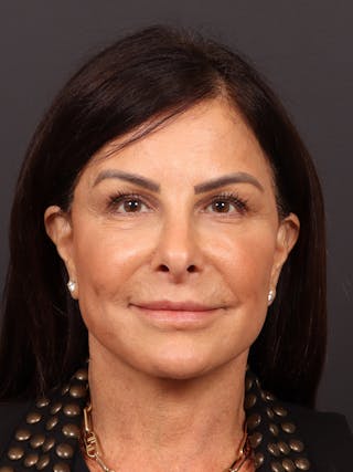 Neck Lift Before & After Gallery - Patient 269680 - Image 2