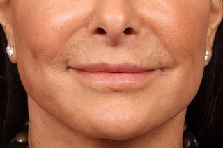 Lip Lift Before & After Gallery - Patient 263922 - Image 2