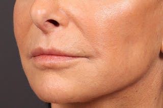 Lip Lift Before & After Gallery - Patient 263922 - Image 4