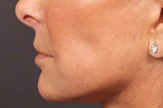 Lip Lift Before & After Gallery - Patient 263922 - Image 6