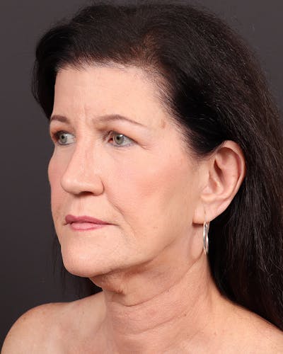 Neck Lift Before & After Gallery - Patient 140580 - Image 1