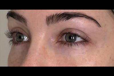PRF/PRP Before & After Gallery - Patient 100798 - Image 2