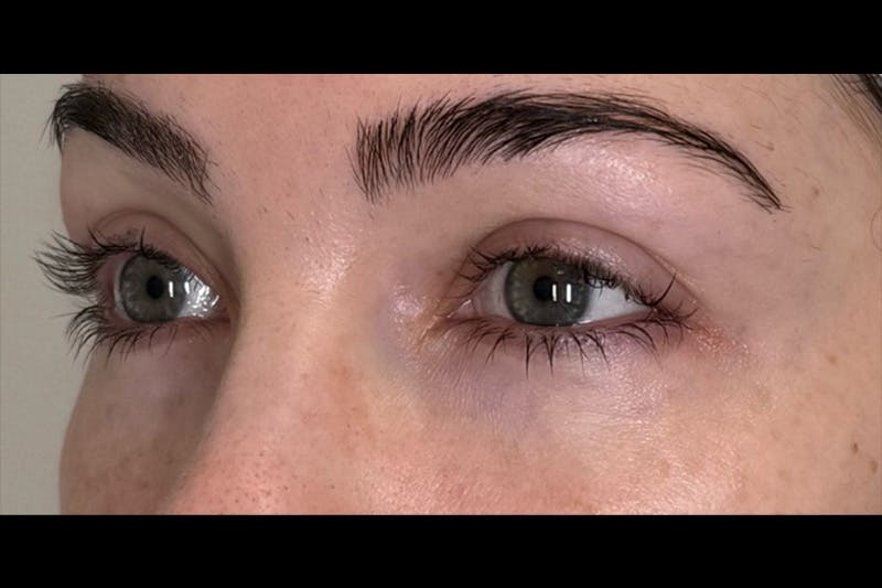 PRF/PRP Before & After Gallery - Patient 100798 - Image 2