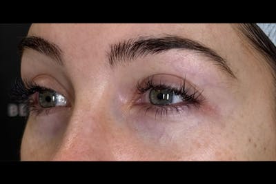 PRF/PRP Before & After Gallery - Patient 100798 - Image 1