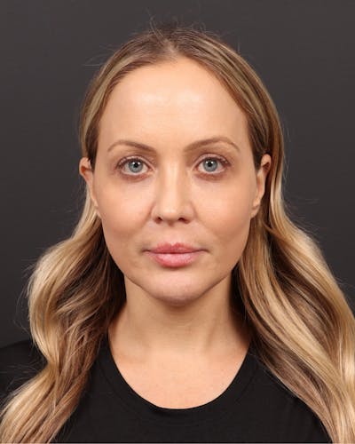 Neck Lift Before & After Gallery - Patient 135542 - Image 1