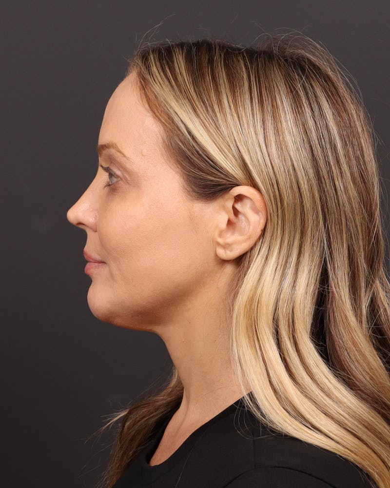 Facelift Before & After Gallery - Patient 110575 - Image 11