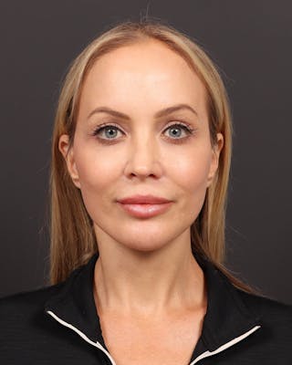 Brow Lift Before & After Gallery - Patient 144762 - Image 2