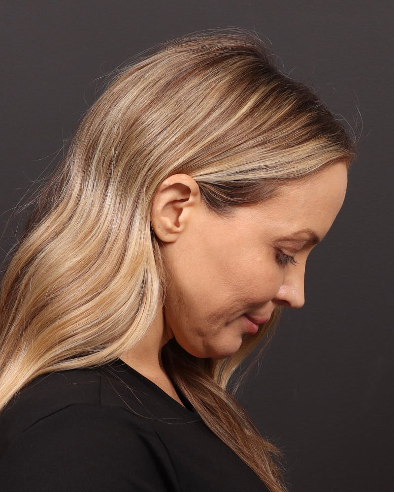 Facelift Before & After Gallery - Patient 110575 - Image 7