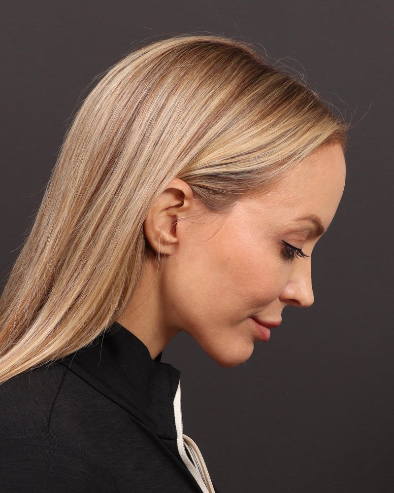 Facelift Before & After Gallery - Patient 110575 - Image 8