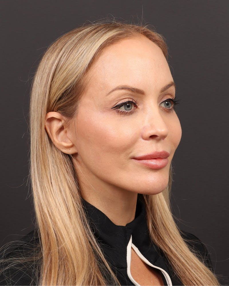 Facelift Before & After Gallery - Patient 110575 - Image 4