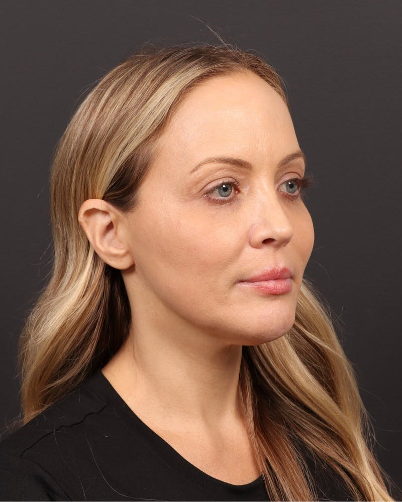Facelift Before & After Gallery - Patient 110575 - Image 3