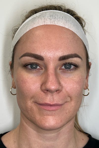 Skin Pen Microneedling Before & After Gallery - Patient 103045 - Image 2