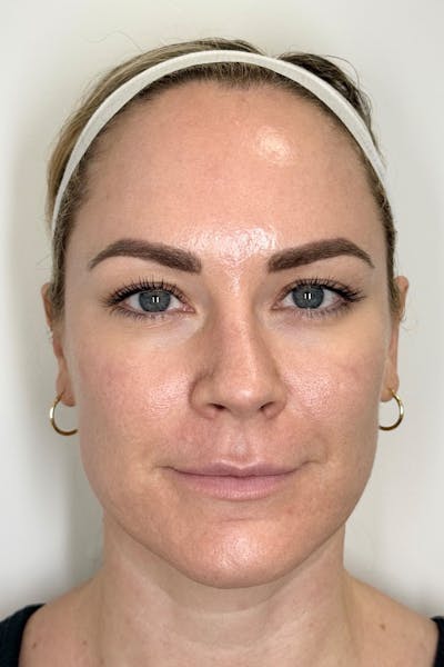Skin Pen Microneedling Before & After Gallery - Patient 103045 - Image 1