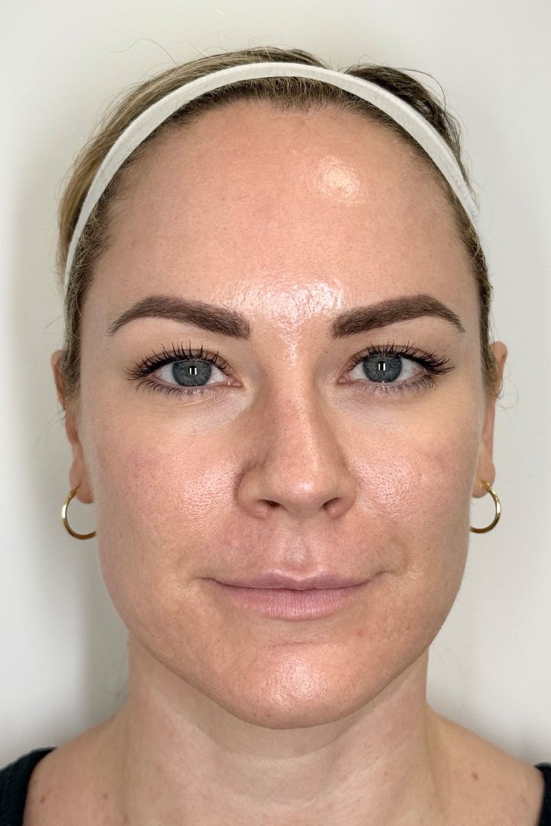 Skin Pen Microneedling Before & After Gallery - Patient 103045 - Image 1