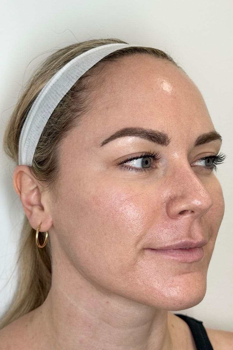 Skin Pen Microneedling Before & After Gallery - Patient 103045 - Image 3