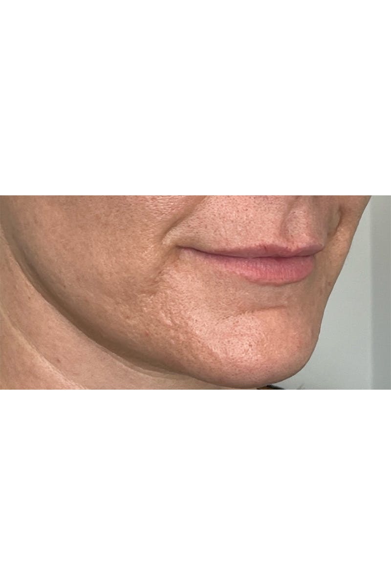 Skin Pen Microneedling Before & After Gallery - Patient 103045 - Image 6