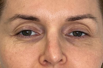 PRF/PRP Before & After Gallery - Patient 351585 - Image 1