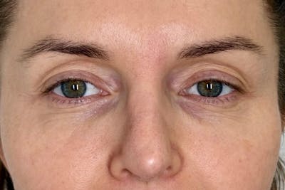 PRF/PRP Before & After Gallery - Patient 351585 - Image 2
