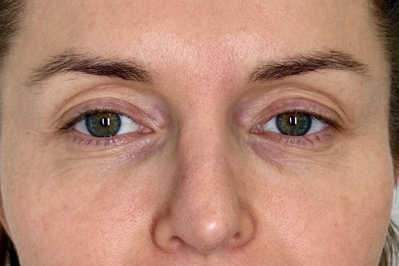 PRF/PRP Before & After Gallery - Patient 351585 - Image 2