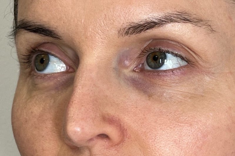 PRF/PRP Before & After Gallery - Patient 351585 - Image 3