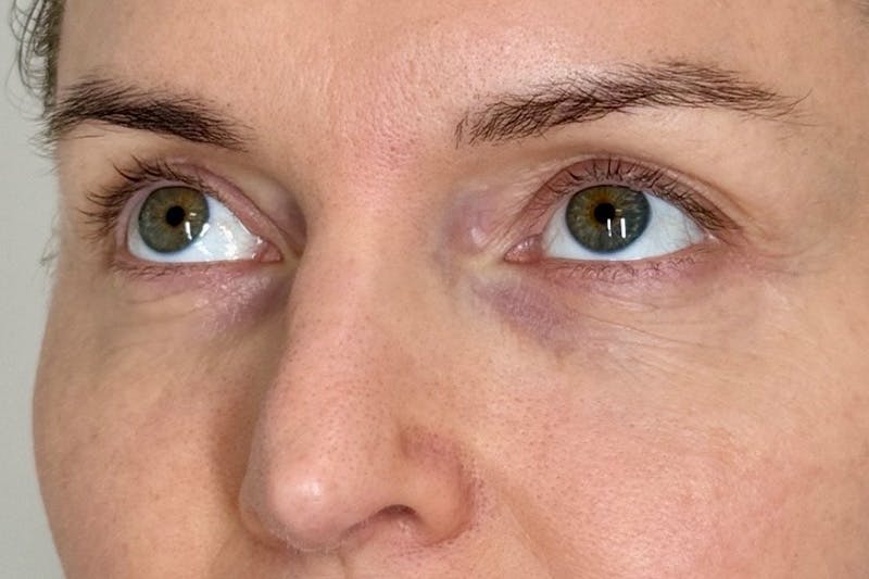 PRF/PRP Before & After Gallery - Patient 351585 - Image 4