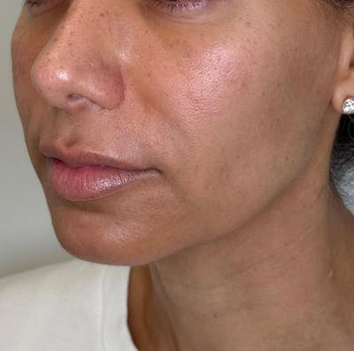 Facial Balancing Before & After Gallery - Patient 524345 - Image 1