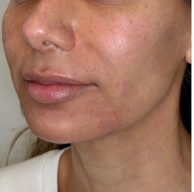Facial Balancing Before & After Gallery - Patient 524345 - Image 2