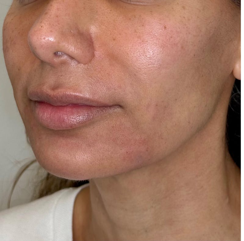 Facial Balancing Before & After Gallery - Patient 524345 - Image 2