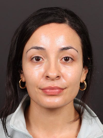 Primary Rhinoplasty Before & After Gallery - Patient 396587 - Image 1