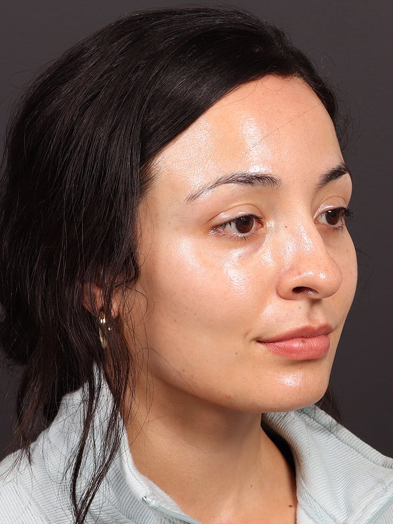 Primary Rhinoplasty Before & After Gallery - Patient 396587 - Image 3