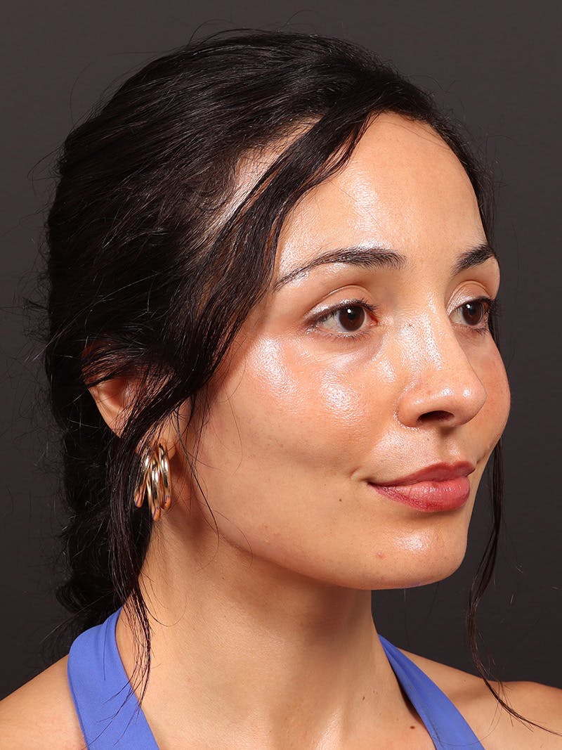 Primary Rhinoplasty Before & After Gallery - Patient 396587 - Image 4