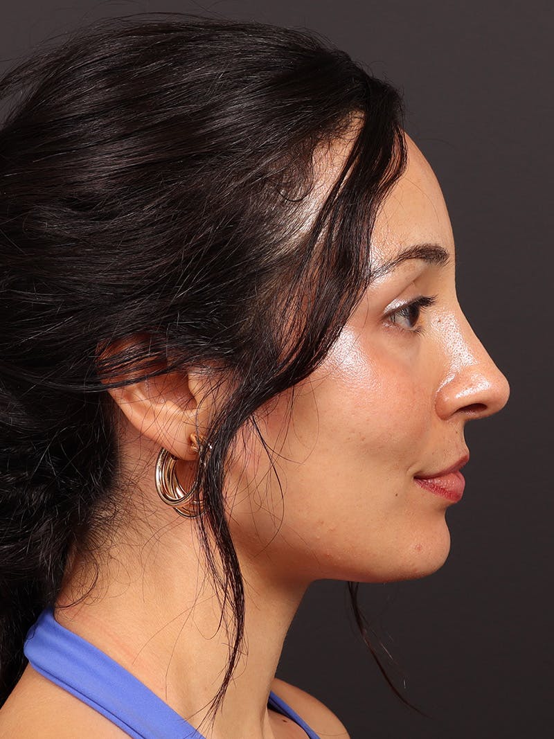Primary Rhinoplasty Before & After Gallery - Patient 396587 - Image 6