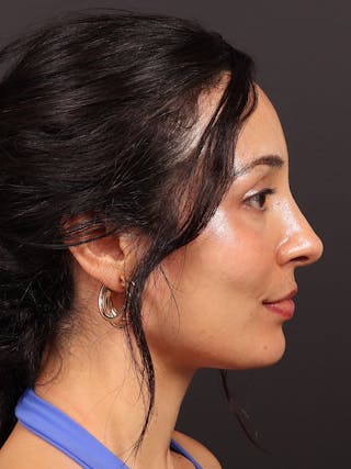 Primary Rhinoplasty Before & After Gallery - Patient 396587 - Image 2