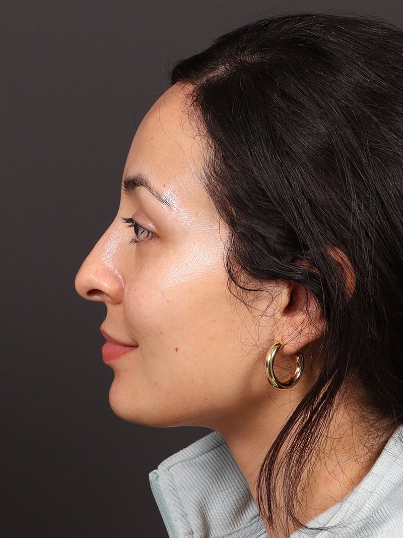 Primary Rhinoplasty Before & After Gallery - Patient 396587 - Image 9