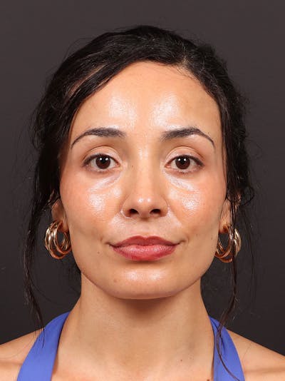 Primary Rhinoplasty Before & After Gallery - Patient 396587 - Image 2