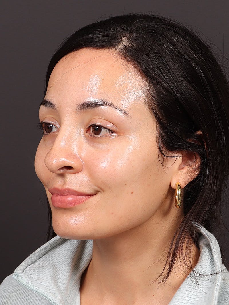 Primary Rhinoplasty Before & After Gallery - Patient 396587 - Image 7