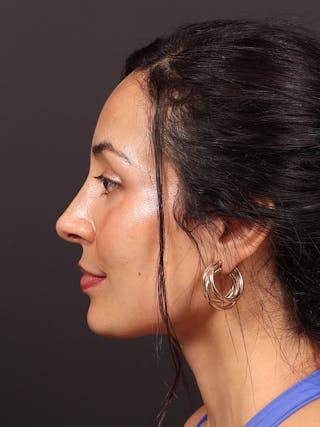 Primary Rhinoplasty Before & After Gallery - Patient 396587 - Image 10