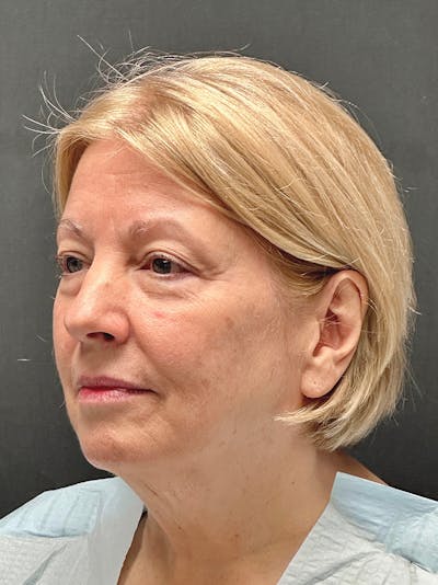 Neck Lift Before & After Gallery - Patient 892236 - Image 1