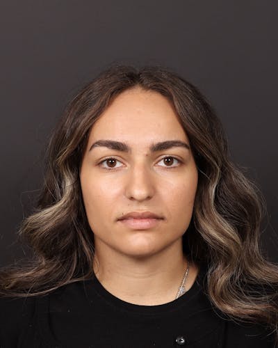 Primary Rhinoplasty Before & After Gallery - Patient 409431 - Image 1