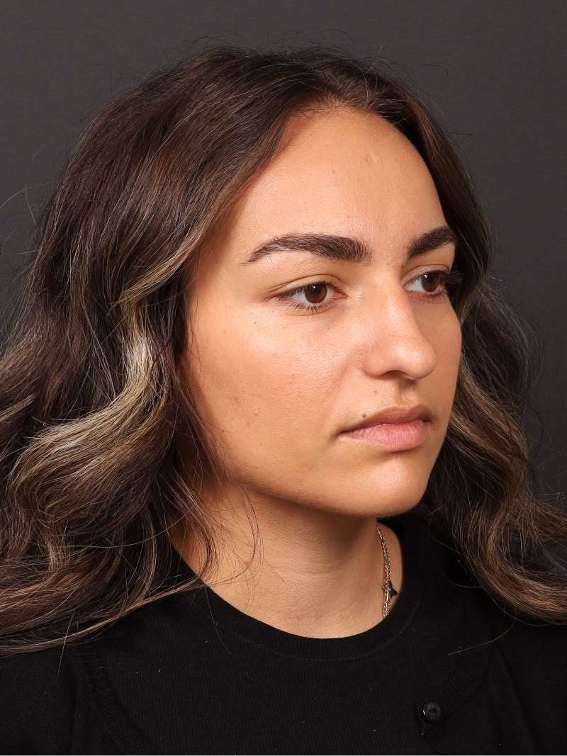 Primary Rhinoplasty Before & After Gallery - Patient 409431 - Image 3