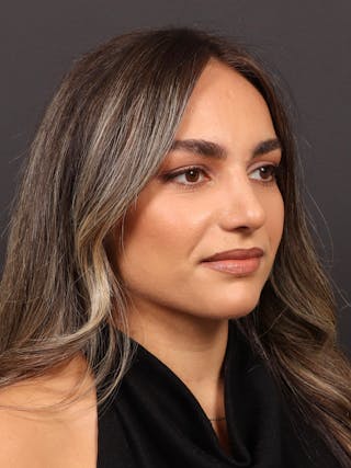 Primary Rhinoplasty Before & After Gallery - Patient 409431 - Image 6